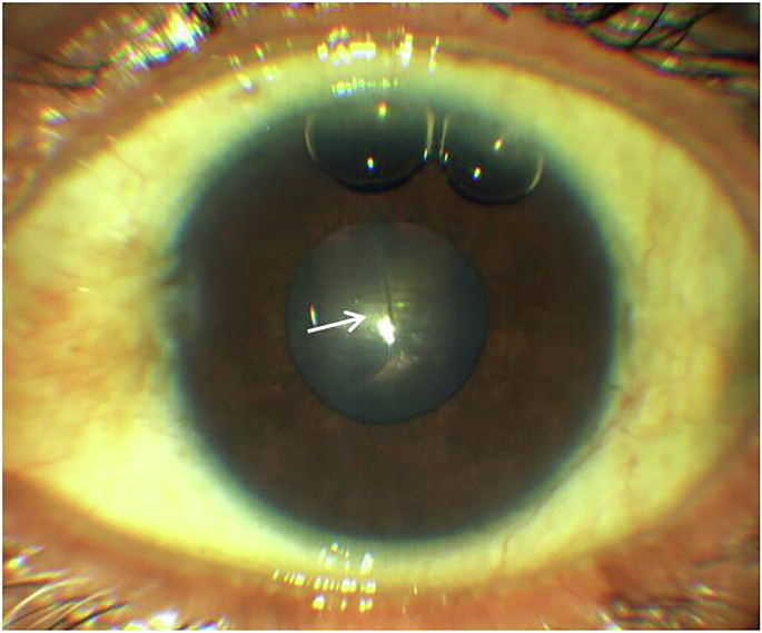 Penetration with inflation: post traumatic air in AC