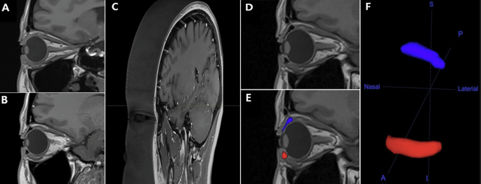 Three-dimensional anatomy and dynamic changes of the conjunctival fornix assessed by high-resolution magnetic resonance imaging