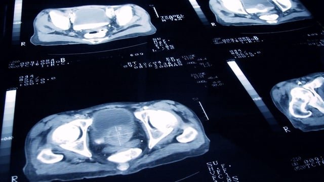 Prostate cancer treatment with fewer side effects & as effective as radiotherapy and surgery