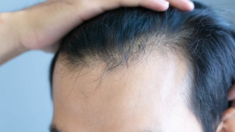 Common Weight Loss Drugs Have Been Linked to a Higher Risk of Hair Loss : ScienceAlert