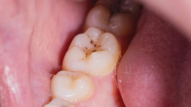 Goodbye, cavities? New gel could regrow tooth enamel