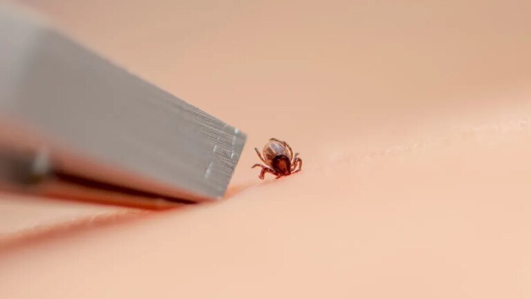 The dos and don’ts of removing a tick