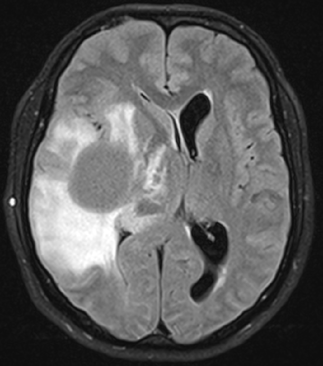 Vaccine Against Brain Tumors Shows Promising Long-Term Results: 33 patients with high-grade astrocytomas, the most common form of glioma, received vaccine that trains the immune system to recognize and fight tumor cells. 66% were still alive after 8 years, and in 42%, the disease had not progressed.