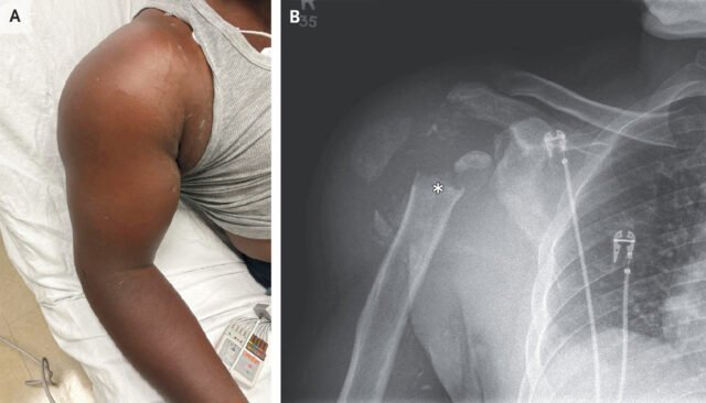 Doctors took a look at man's painful shoulder—they found the joint was missing